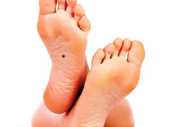 Nếu trong lòng bàn chân có nốt ruồi đen, bạn nên vui mừng vì đó là dấu hiệu đáng mừng. (Ảnh: Internet)