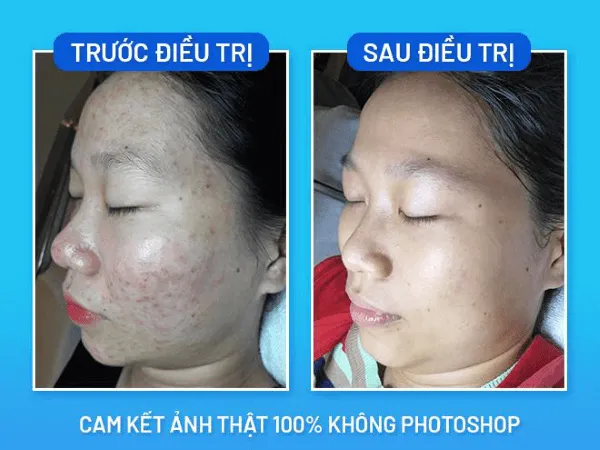 Kết quả điều trị mụn thành công sau khi điều chỉnh chế độ sinh hoạt